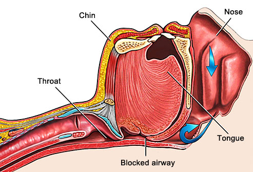 How Gedova® Anti-Snore Mouthpiece Works