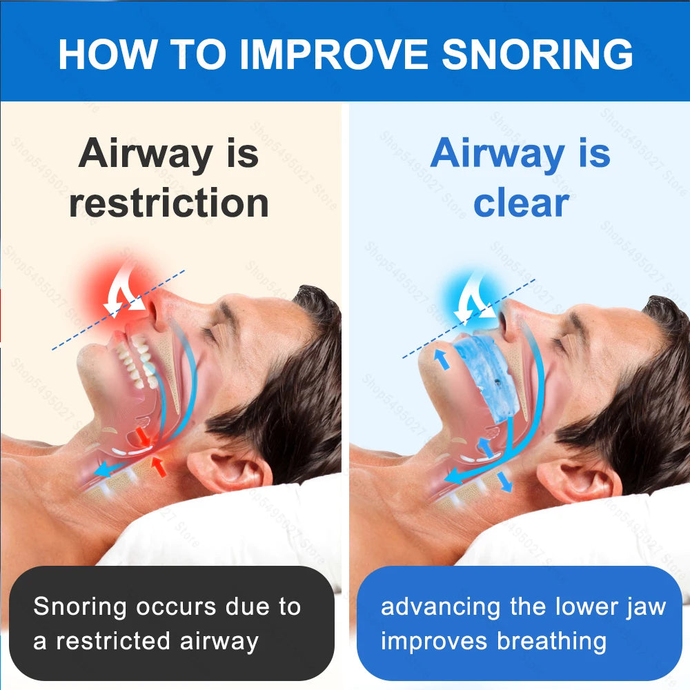 Gedova® Anti-Snore Mouthpiece